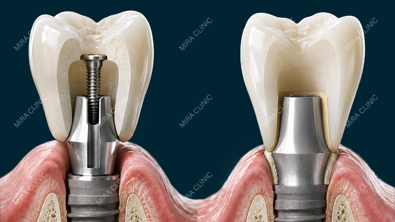 Screw Retained vs Cement Retained Implants